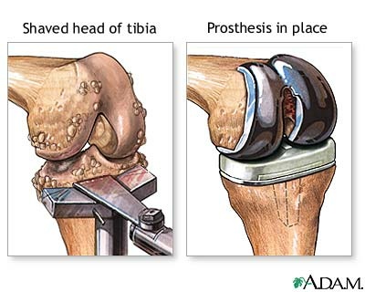 knee-bone&prosthesis.jpg